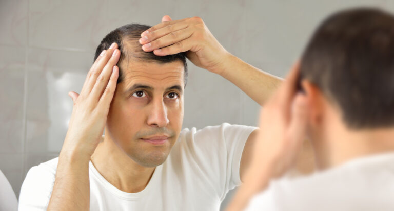 Featured image for What Causes Hair Loss