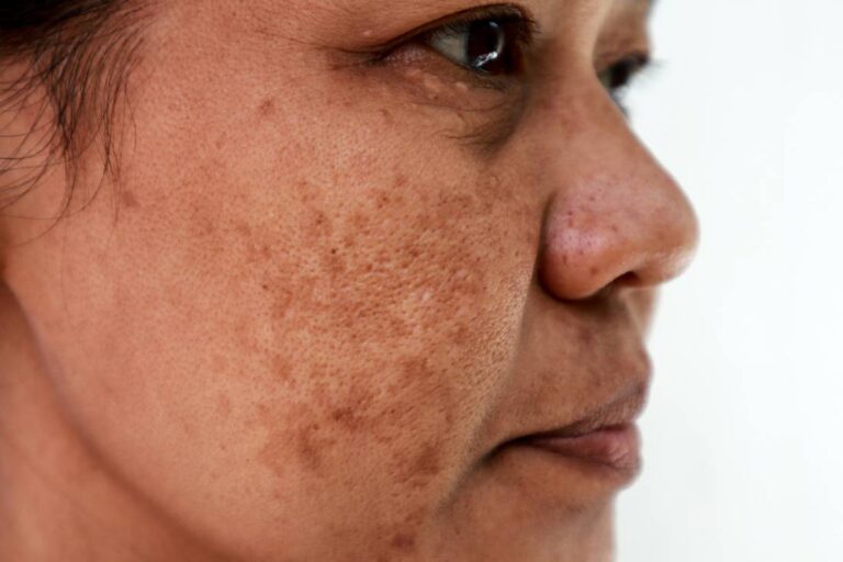 Featured image for How to Prevent Melasma