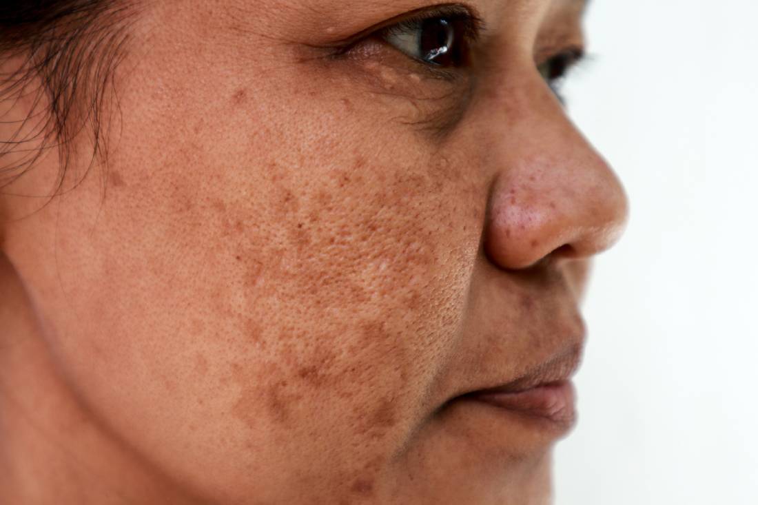 Featured image for How to Prevent Melasma